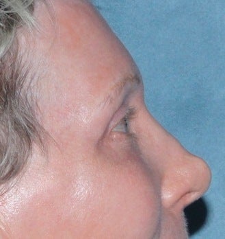 Laser resurfacing around eyes after 376160