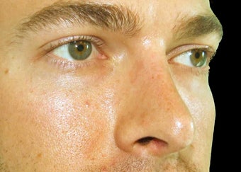 Rhinoplasty after 114369