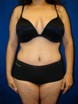 Extended Tummy Tuck (abdominoplasty) after 128663