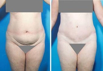 Abdominoplasty before 356396