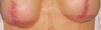 Breast implant scar removal before 376104