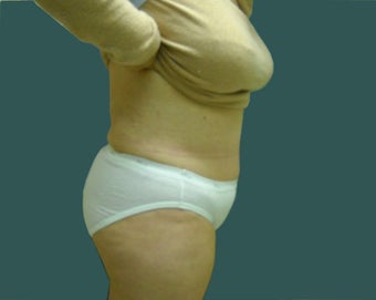 Extended abdominoplasty 561153