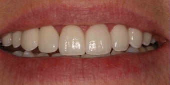 Porcelain Veneers and Crowns after 485379