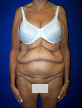 Extended Tummy Tuck Surgery before 133931