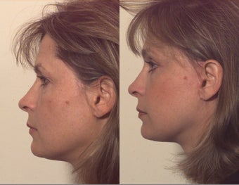 Composite facelift after 102532