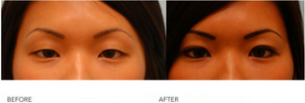 Asian Blepharoplasty ("Double Eyelid" Procedure) before 136817
