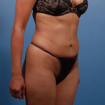 Liposuction after 207568