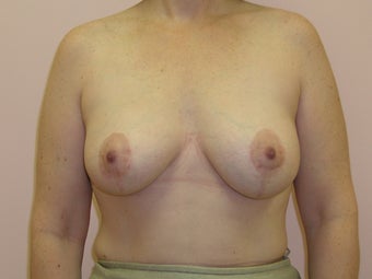 Breast Lift with Implants 312862