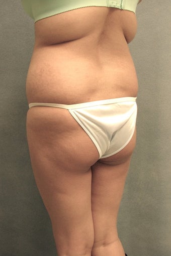 Brazilian Buttock Lift before 76687