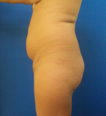 Brazilian Butt Lift 367233