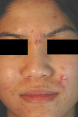 Photodynamic Therapy for Acne before 86366
