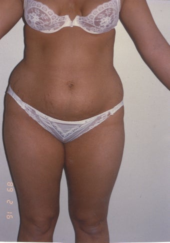 Liposuction before 211935