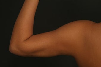 Liposuction 315604