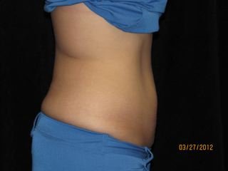 Coolsculpting after 531062