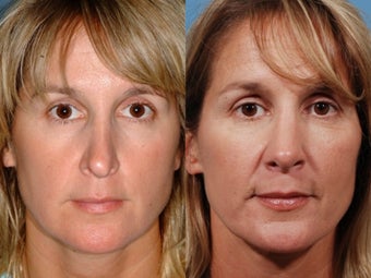 Revision rhinoplasty before 355710