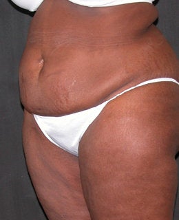 Tummy Tuck with Flank Liposuction 330898