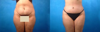 Tummy Tuck and Liposuction before 134090