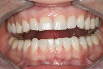 Whitening and Bonding before 112131