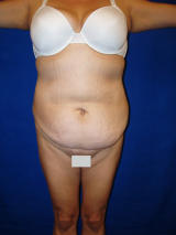 Tummy Tuck Surgery (abdominoplasty) before 129744