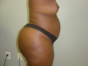Mommy makeover - side view before 620903