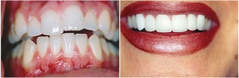 Veneers before 152664