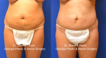 Mini Tummy Tuck before 568405