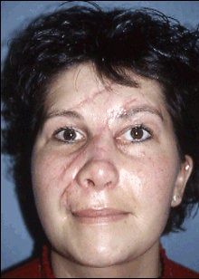 Facial Scar Improvement before 598645