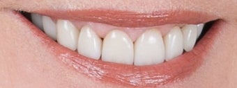 Orthodontics, all porcelain veneers, gum re-contouring after 503144