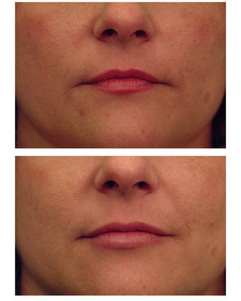 Juvederm before 301145