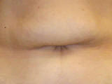 Belly Buttons after Tummy Tuck Surgery before 133865