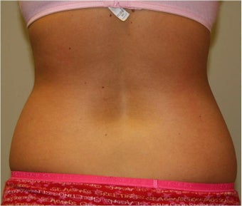 SmartLipo Love Handles Posterior View before 109443
