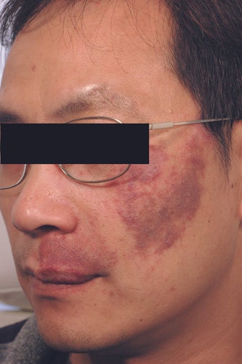 Port Wine Birthmark Removal before 502725