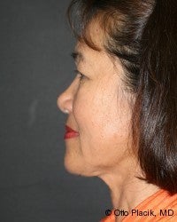 Neck Lift 567432