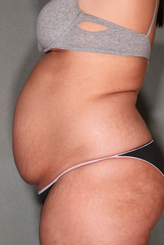 SmartLipo™ 529476