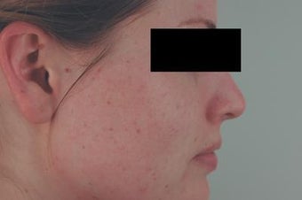 Laser Acne Scar Removal after 82979