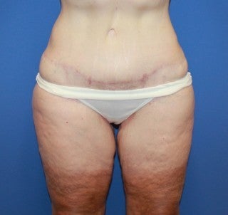 Inner thigh lift after 486116