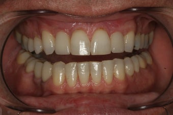 Whitening and Implants after 213055