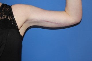 Brachioplasty after 368687