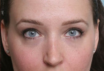 Eyelid Surgery after 118538