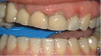 crown lengthening on temporary crowns before 607255