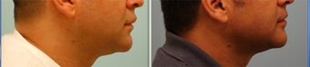 Male Upper Lip Reduction 309222