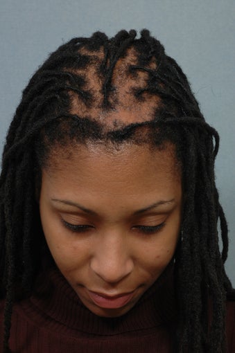Hair Transplantation 358867