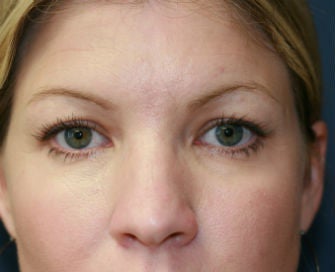 blepharoplasty before 568987