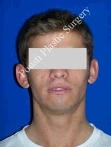 Ear Surgery (Otoplasty) 616578