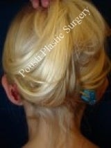 Ear Surgery (Otoplasty) 579109