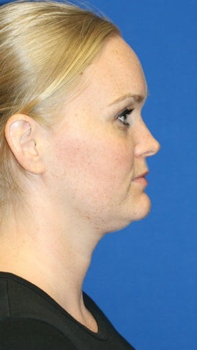 1 month post op: Necklift & Neck Liposuction before 480354
