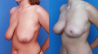 Breast Lift before 122856