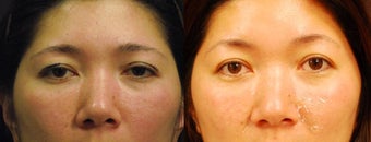 Brow lift before 551876