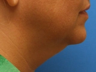 Lower Facelift with Submental Liposuction (Liposuction under the chin) before 243863