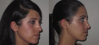 Facial Rejuvenation, non-surgical 450123